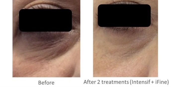 Lower Facial Jawline Contouring and Lift